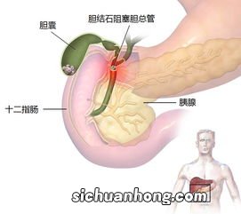 胆结石切胆术后吃什么