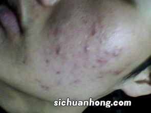 痤疮能喝什么汤