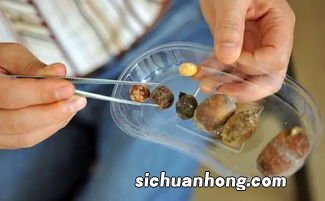 肾结石喝什么饭好