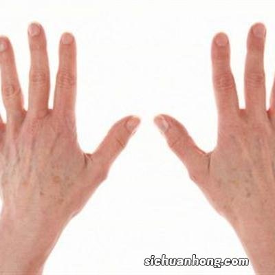 湿疹症状有哪些