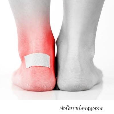 足癣最佳治疗方法有哪些