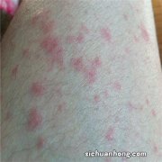 泛发型湿疹怎么治疗