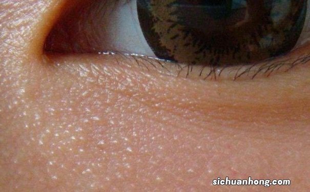 什么是脂肪粒?产生脂肪粒的原因有哪些?