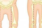 宝宝O型腿怎么矫正