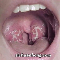咽炎应该吃什么