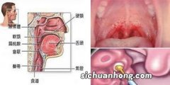 咽喉炎适合吃什么食物