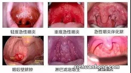 咽喉炎适合吃什么食物