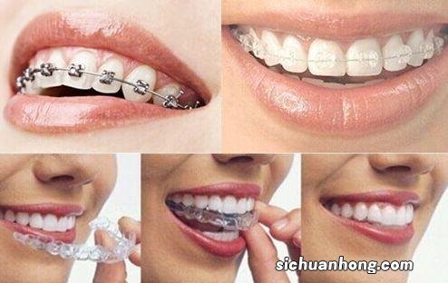 矫正牙齿后吃什么饭呀