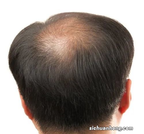 吃什么对脱发有用