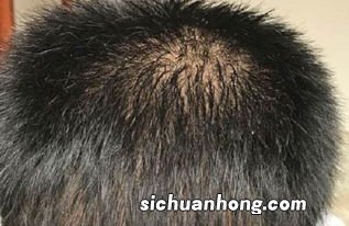 青年人掉发吃什么