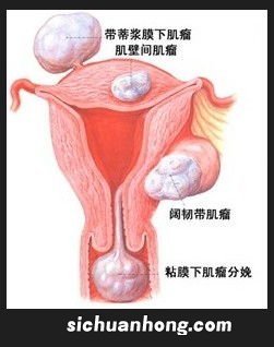 吃什么食物能消除子宫肌瘤