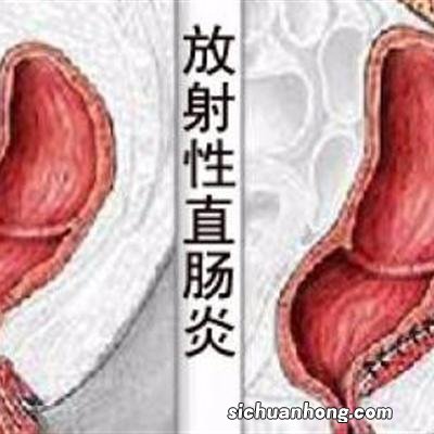 慢性直肠炎吃什么菜好