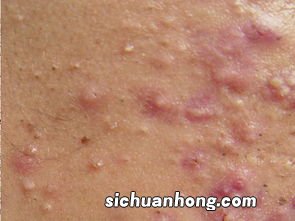 过敏应该注意些什么东西不能吃什么