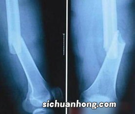 骨折患者该吃什么