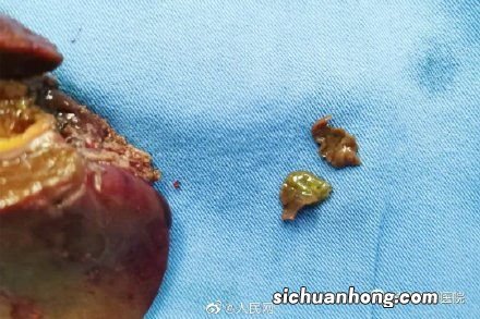 荸荠要煮多久能杀死姜片虫