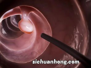 得痔疮后吃什么好