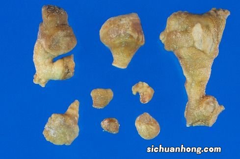 得了肾结石什么不能吃什么食物好