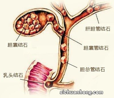 胆囊炎可以吃什么吗