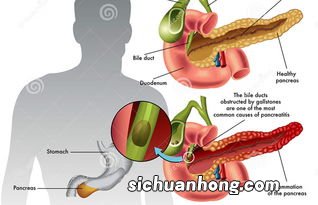 胆结石应该吃什么东西不能吃