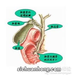 胆结石应该吃什么东西不能吃