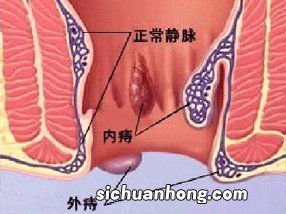 吃什么痔疮会好一点